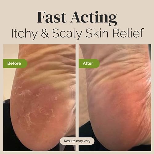 Tea Tree Oil Balm , Extra Strength, Pair Well with Jock Itch Cream, Spray, Athletes Foot