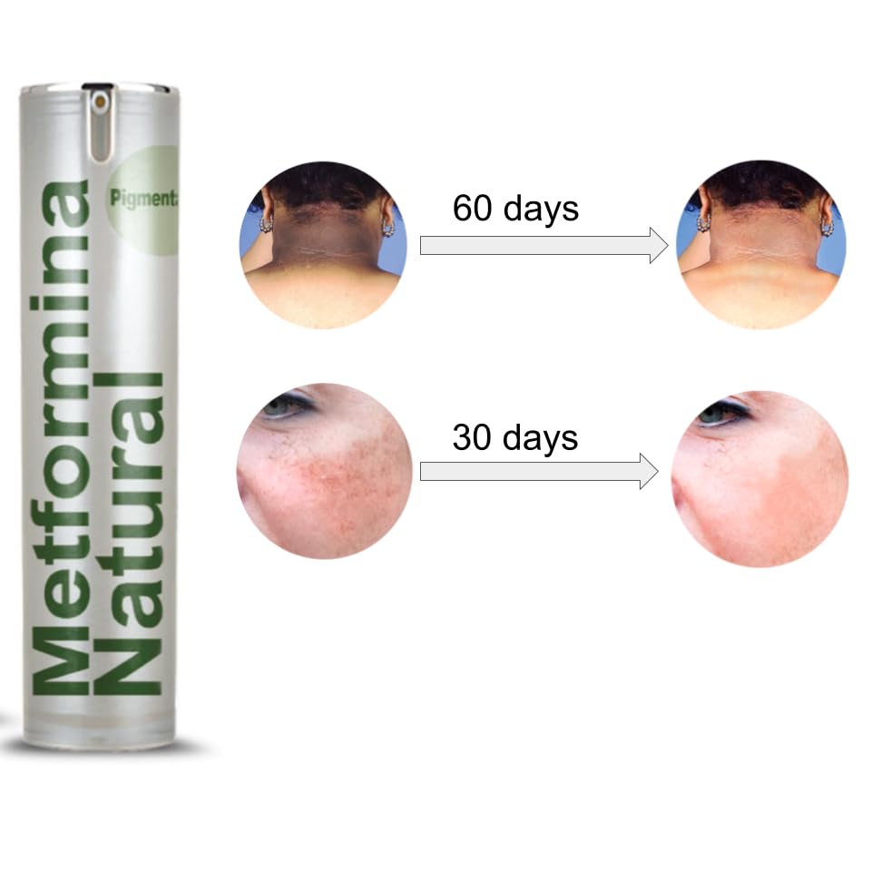 Ni una dieta más METFORMINA NATURAL - Cream for Dark Spots on Face and Body