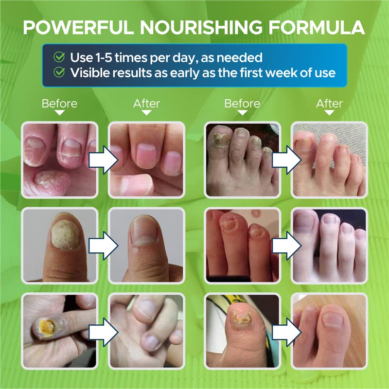 Toenail Fungus Treatment Extra Strength - Fungal Nail Treatment for Toe Nail & Fingernails