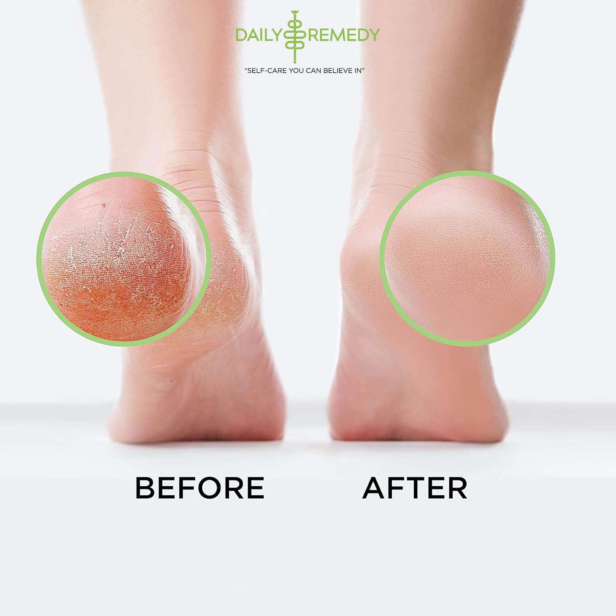 Tea Tree Oil Foot Soak with Epsom Salt - Made in USA - for Toenail Athletes Foot