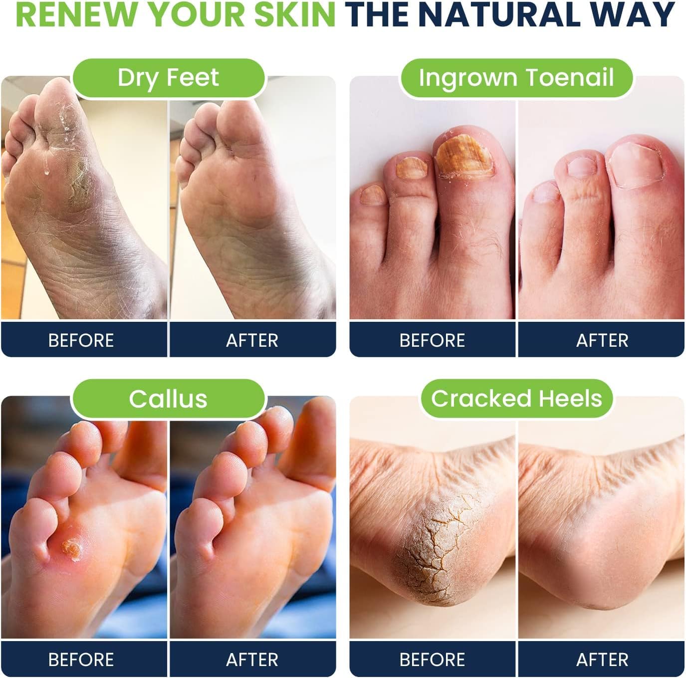 Tea Tree Oil & Citrus Detox Foot Soak with Epsom Salts - All Natural Salts for Post Workout