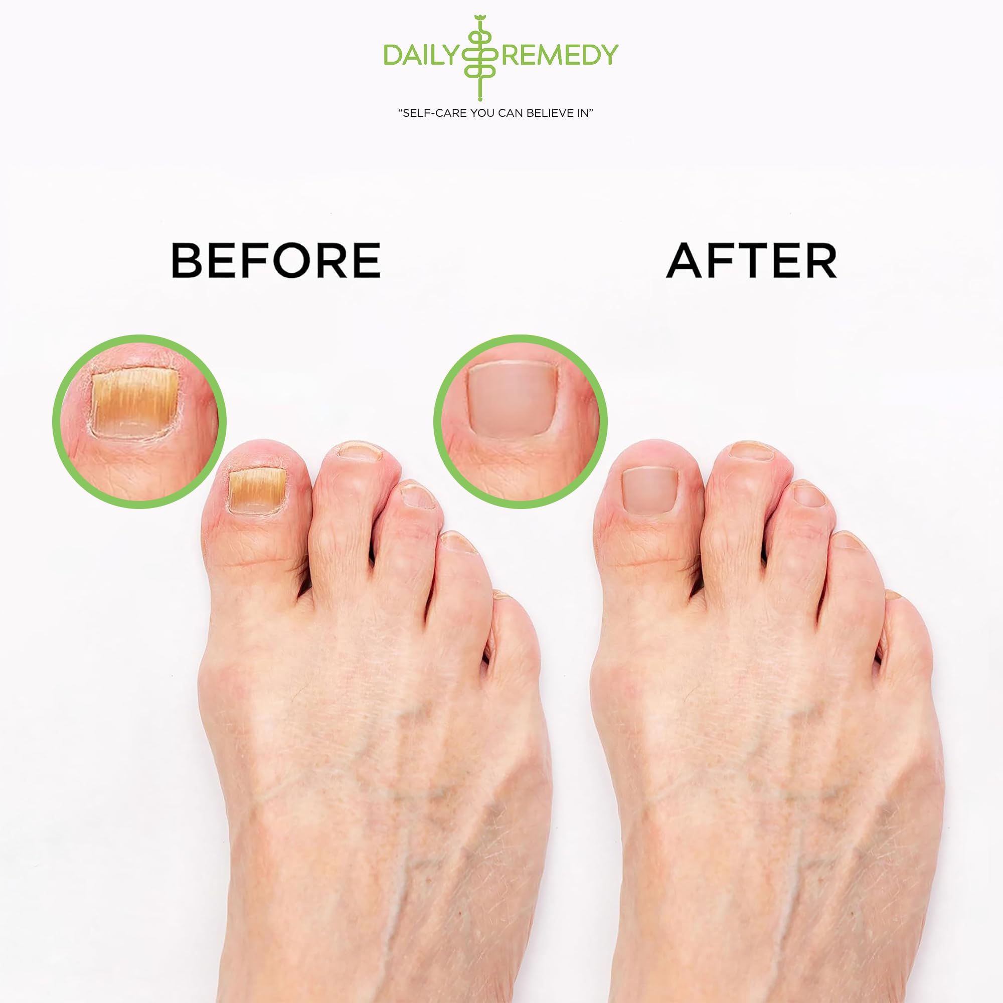 Tea Tree Oil Foot Soak with Epsom Salt - Made in USA - for Toenail Athletes Foot