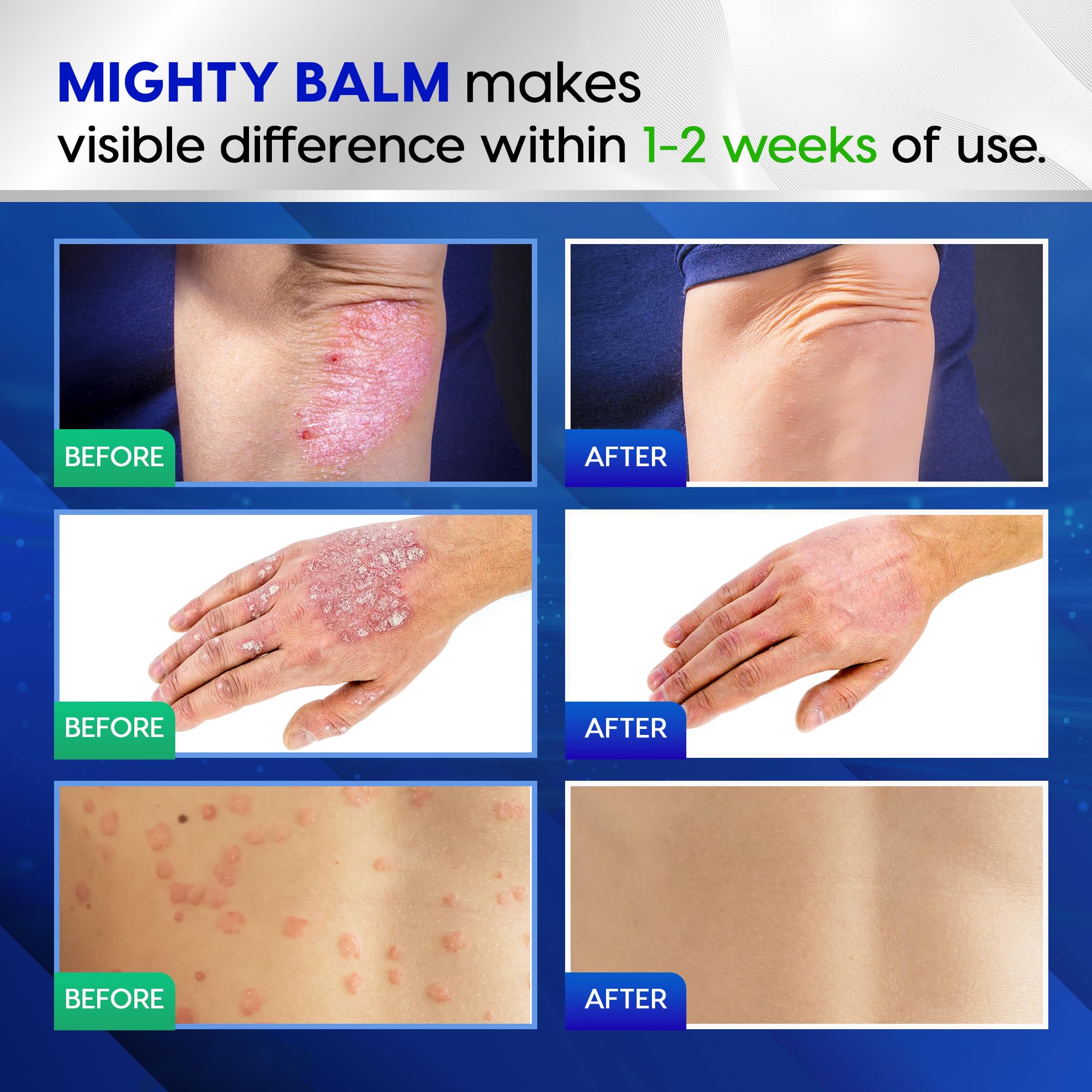 Tobcharm Antifungal Cream, Antifungal Cream for Skin, Ringworm Treatment for Humans