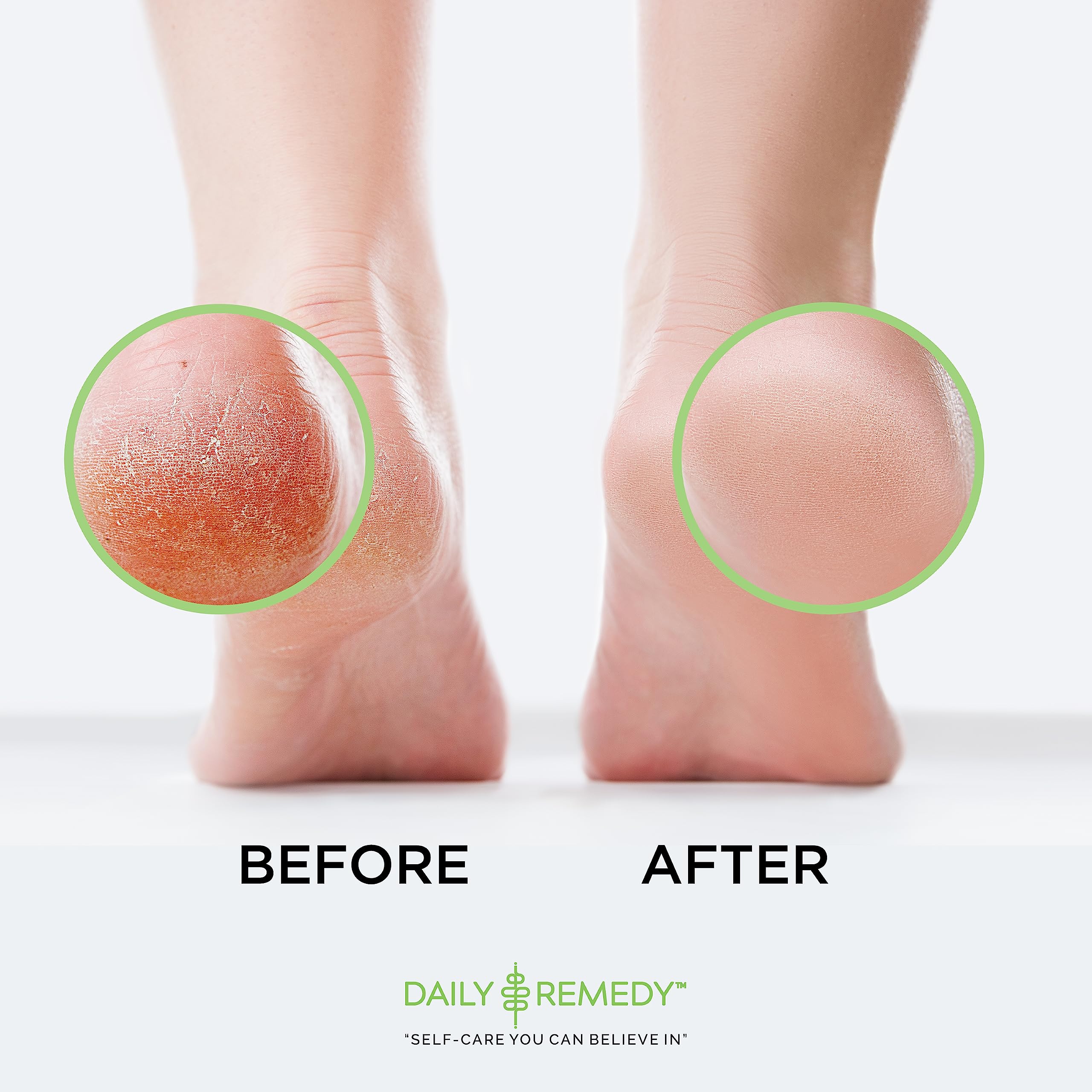 EXTRA STRENGTH Tea Tree Oil Foot Soak with Epsom Salt - Made in USA - for Toenails